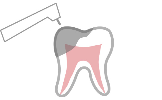 1.虫歯、汚染部位の除去